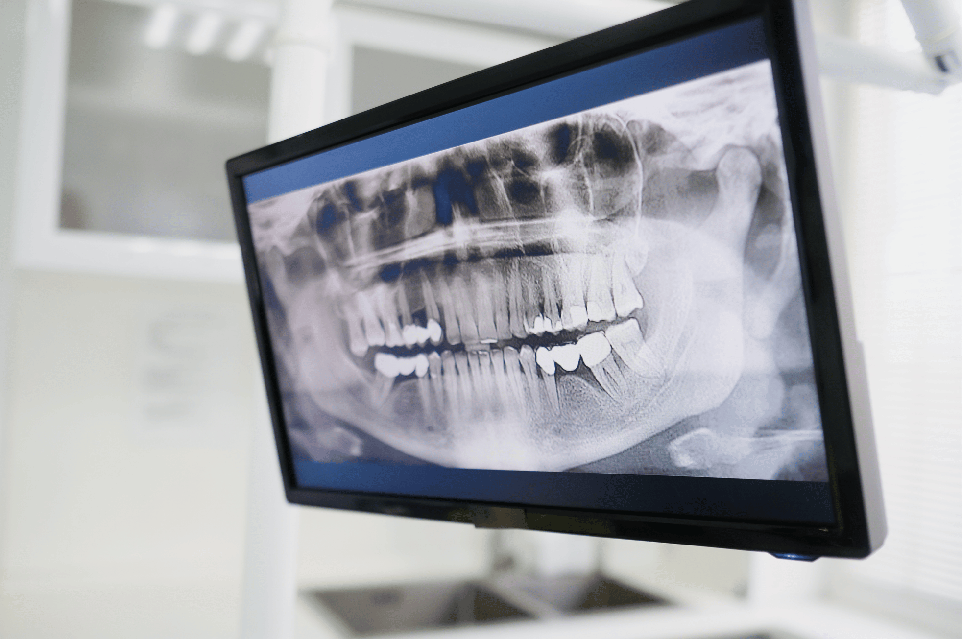 teeth xray on a screen